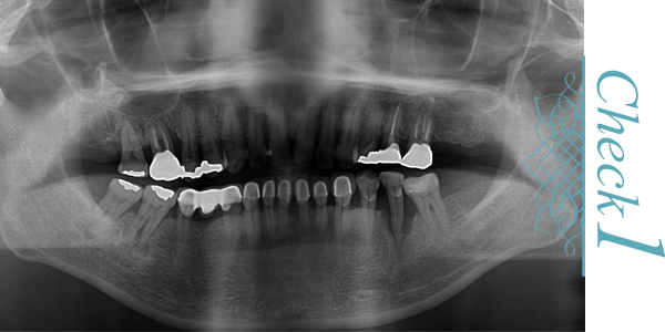 歯周病検査項目1：レントゲン撮影