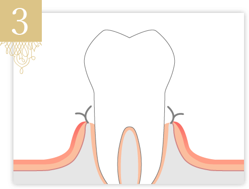 切り取った歯肉の先端を、歯槽骨の位置に合わせて根尖側に移動させて縫いつけます