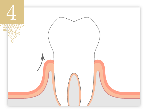 約1週間後、抜糸します。歯肉は歯冠側に向かって治癒、歯周ポケットのない健康的な歯ぐきへと回復します
