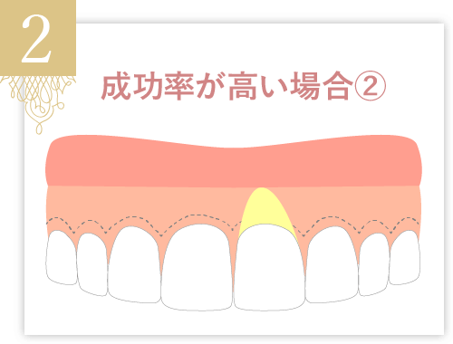 歯肉移植の成功率が高い場合②