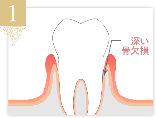 歯周病によって骨欠損（骨吸収）が生じます