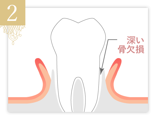 歯肉を剥離し、歯根面を清掃、整形します