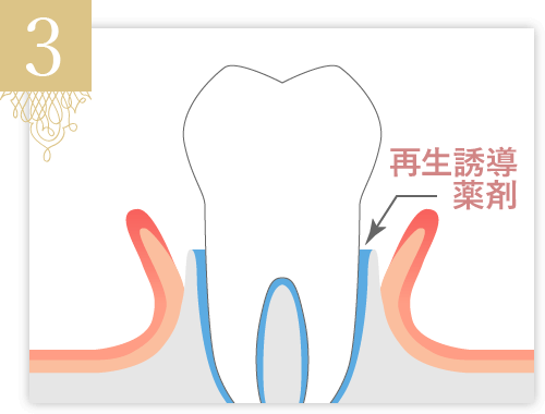 歯周組織再生誘導薬剤を歯の周りに、注入します