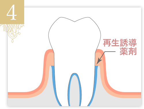 歯肉を元に戻し、治癒を待ちます