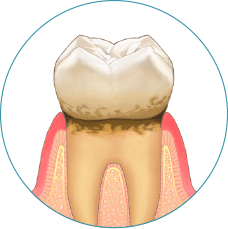 歯周病の第1段階：歯肉炎