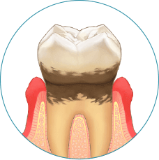 歯周病の第2段階：軽度歯周病