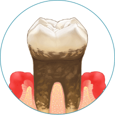 歯周病の第3段階：中度歯周病